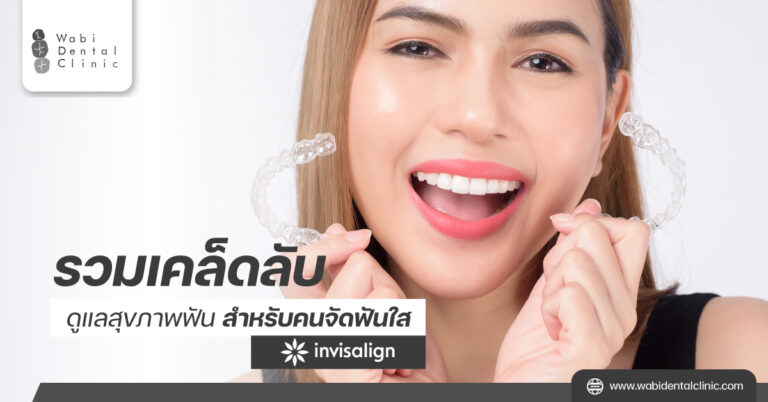 รวมเคล็ดลับดูแลสุขภาพฟันสำหรับคนจัดฟัน ด้วยนวัตกรรมจัดฟันใส Invisalign
