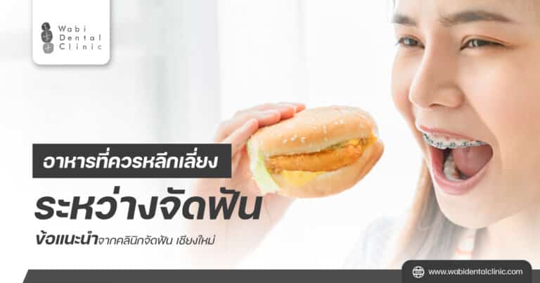 อาหารที่ควรหลีกเลี่ยงระหว่างจัดฟัน ข้อแนะนำจากคลินิกจัดฟัน เชียงใหม่